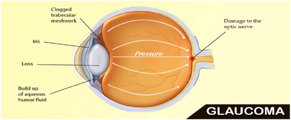 Glaucoma